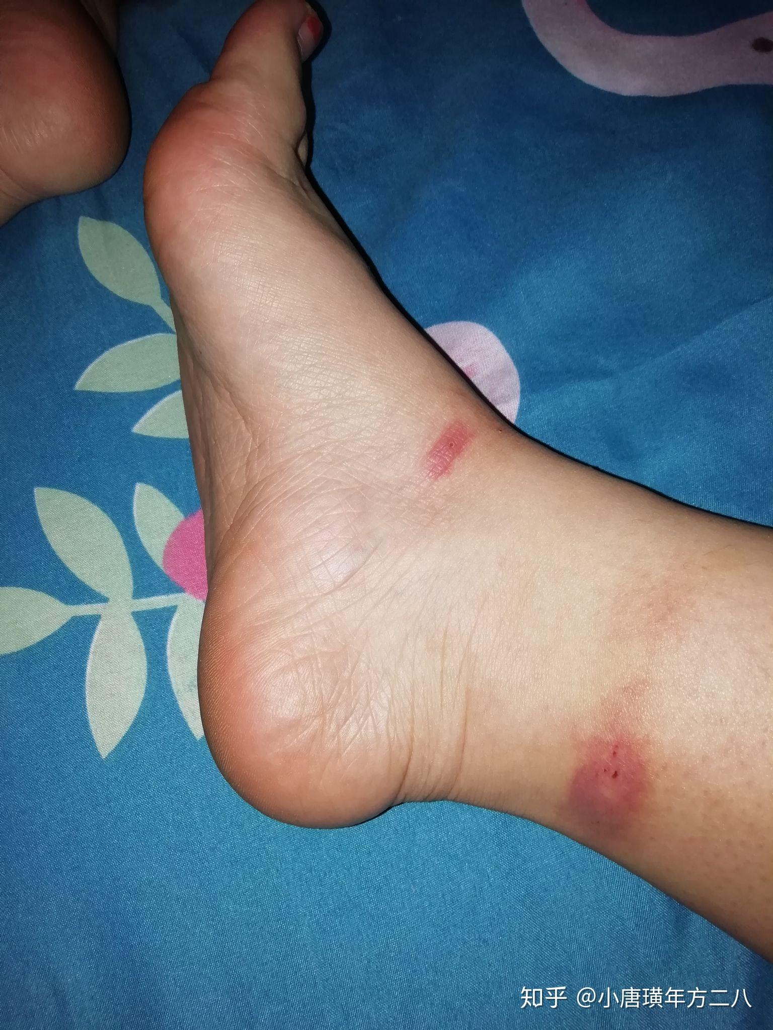 为什么有的人被蚊子咬后是起一个大包,有的人则是出现一个红点?