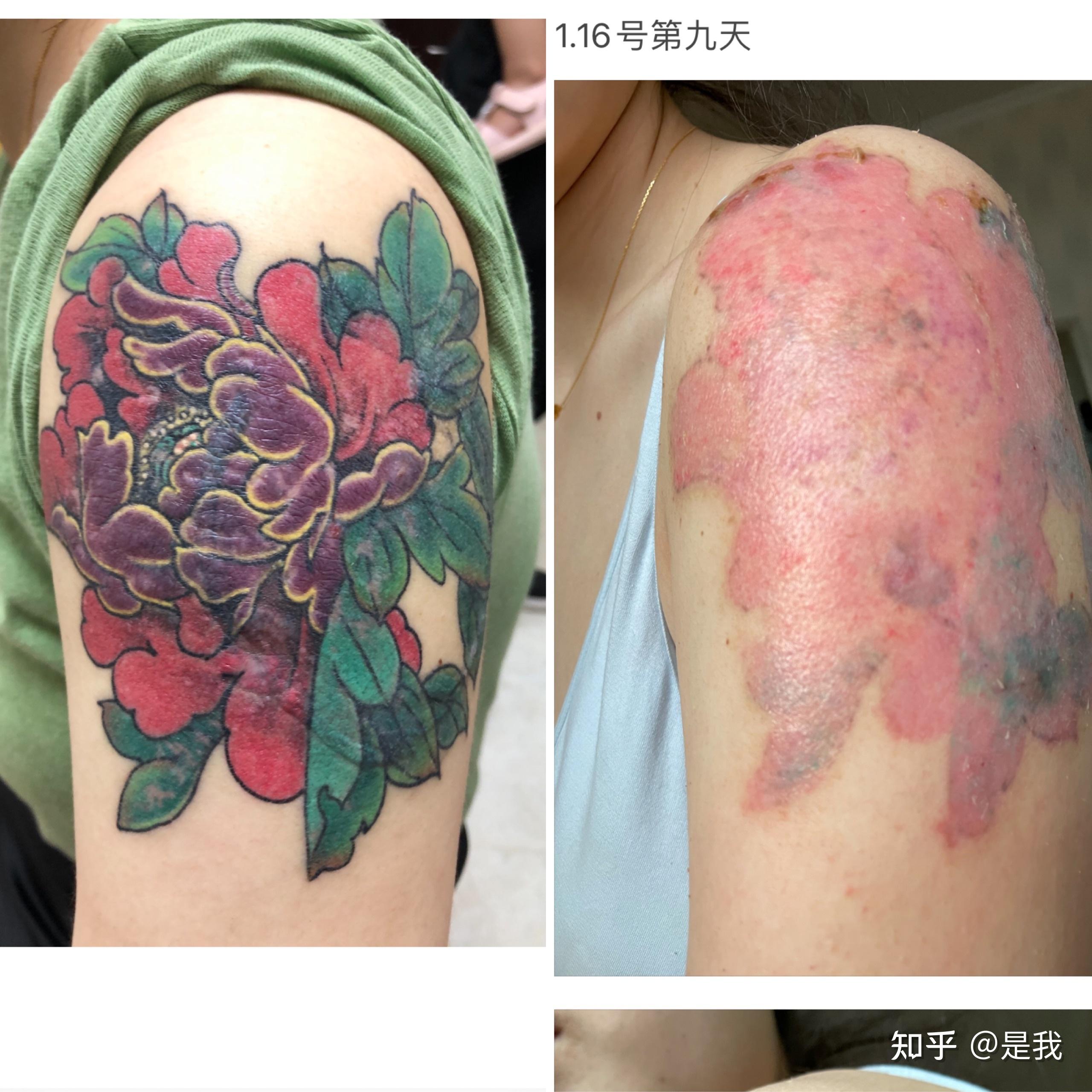 想去湘雅医院洗纹身 湘雅医院洗纹身的效果好不好? - 知乎