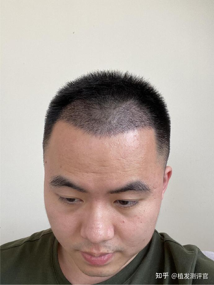 专业生发植发(植发生发属于什么行业)