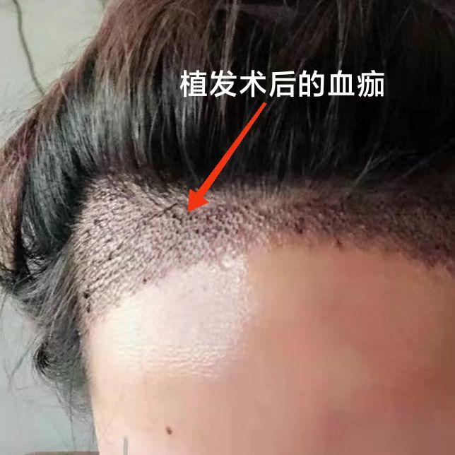 植发后多久清理血痂比较好呢? - 知乎