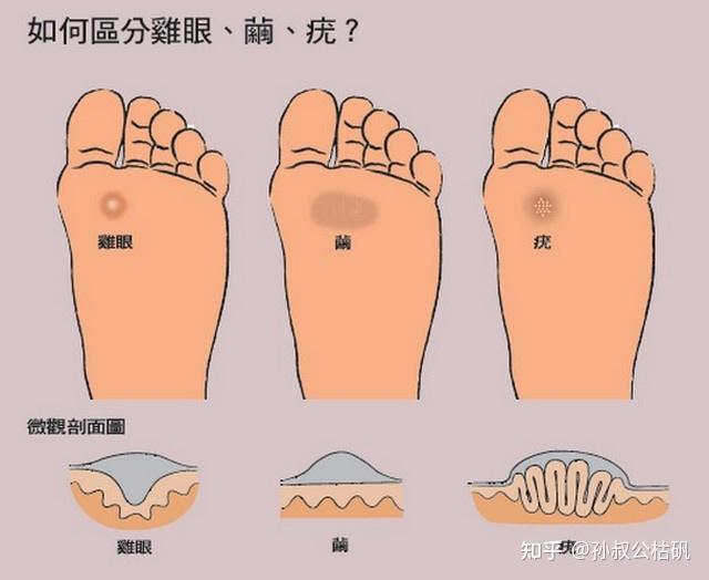 跖疣与鸡眼的区别图图片