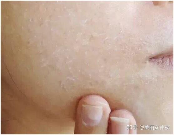 粉底浮粉,卡粉,还有皮肤有干纹具体是什么样子的? - 知乎