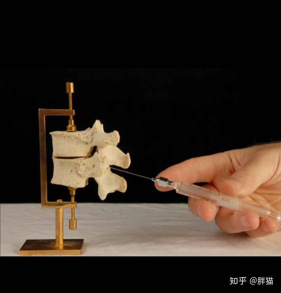 无痛分娩针多粗