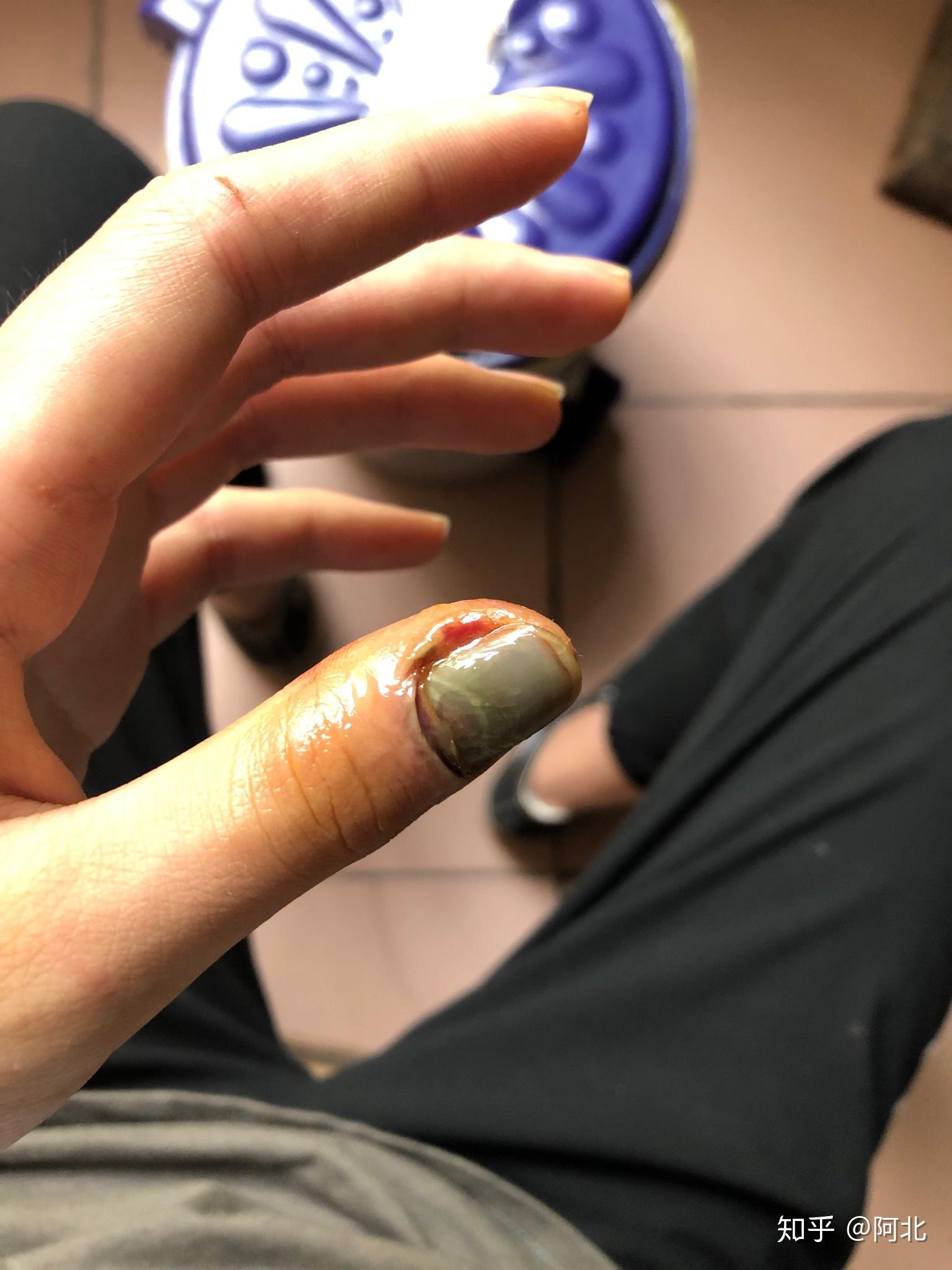 手指被门夹肿还夹出淤血是什么感受