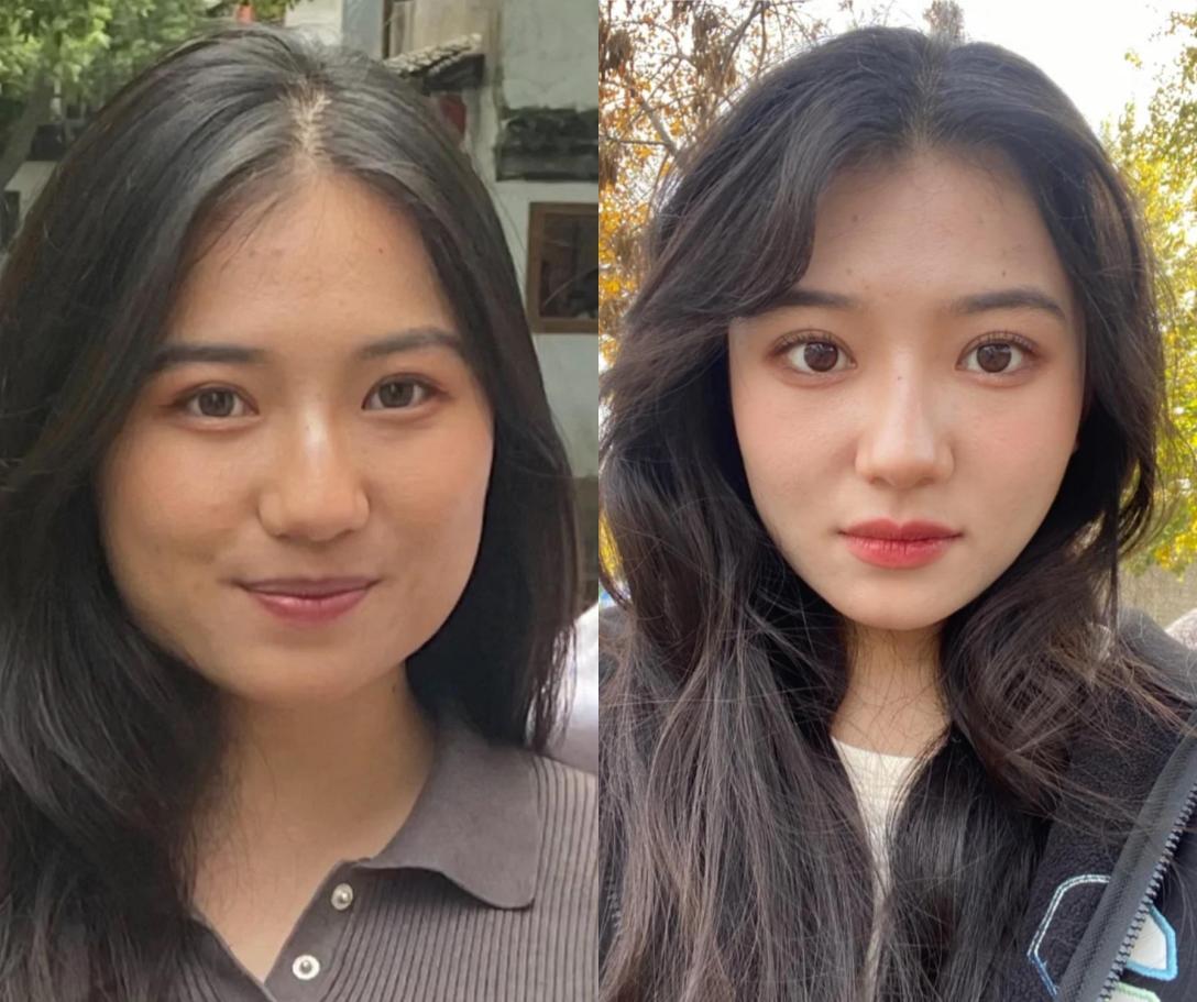 做完面部吸脂有效果吗?