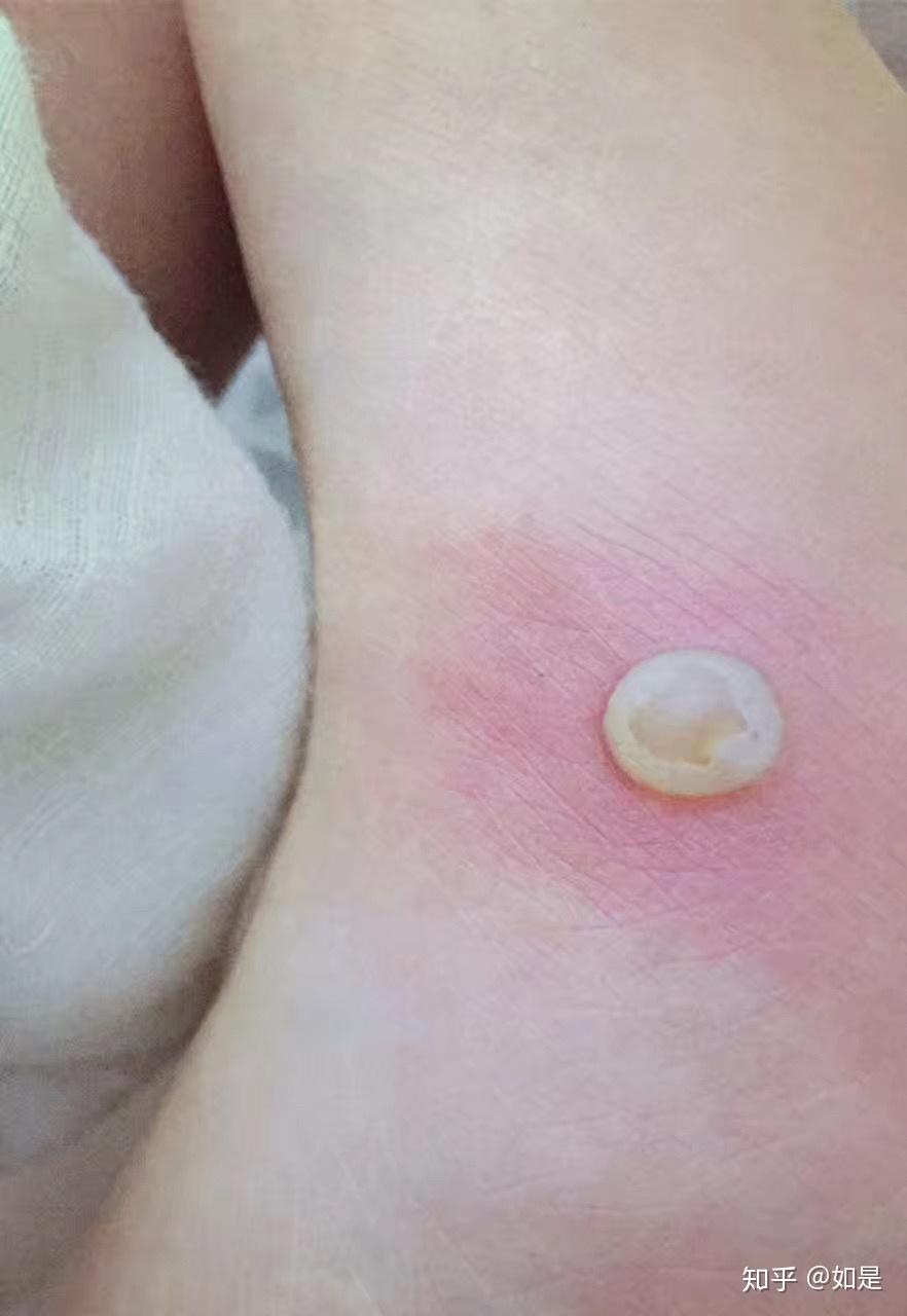 被毒蚊子咬了 肿了很大一个包 还很硬 之后肿的包上面起了水泡 挑破