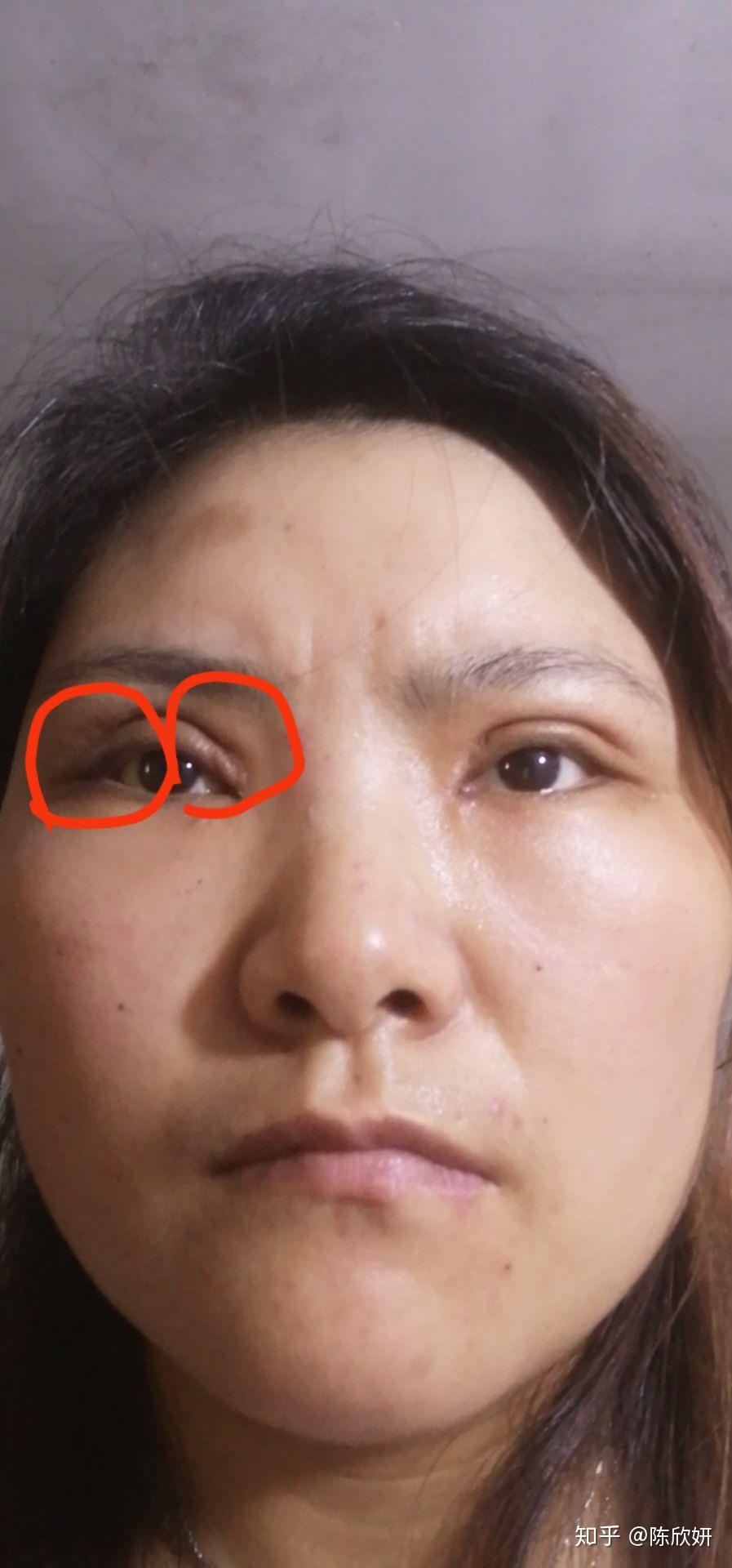 割双眼皮失败是什么样子的?