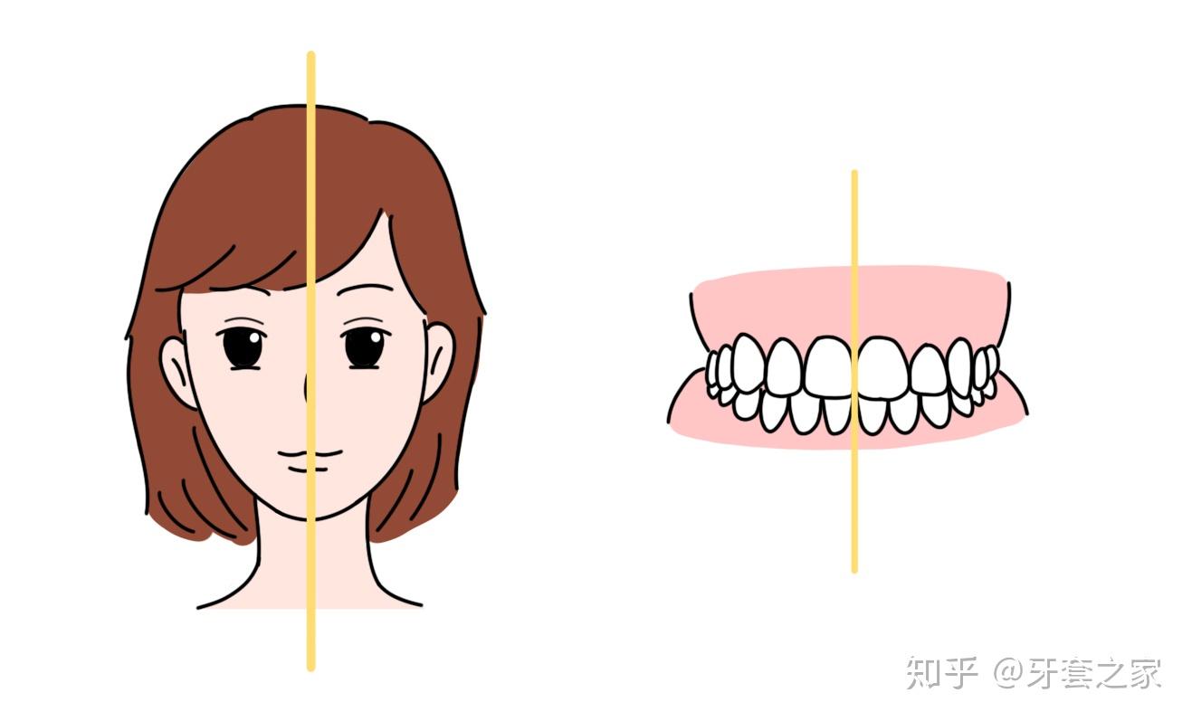 安氏一二三类错牙合都是什么样的