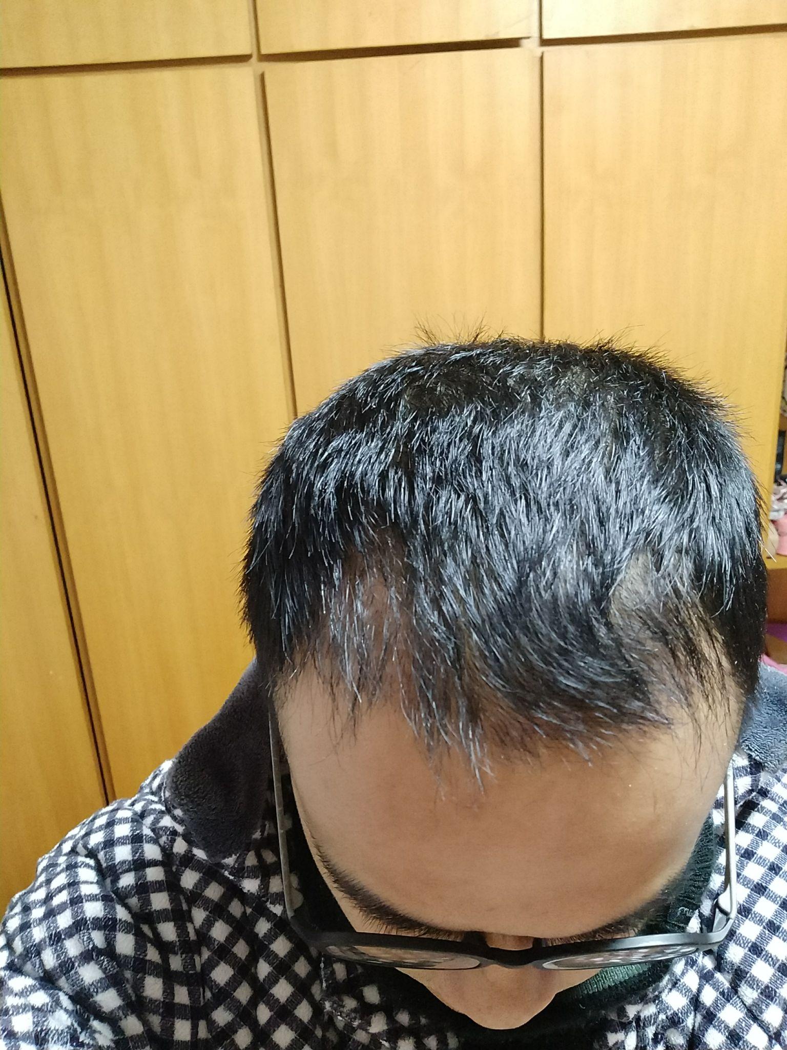 南京论坛植发(南京哪里植发最好)