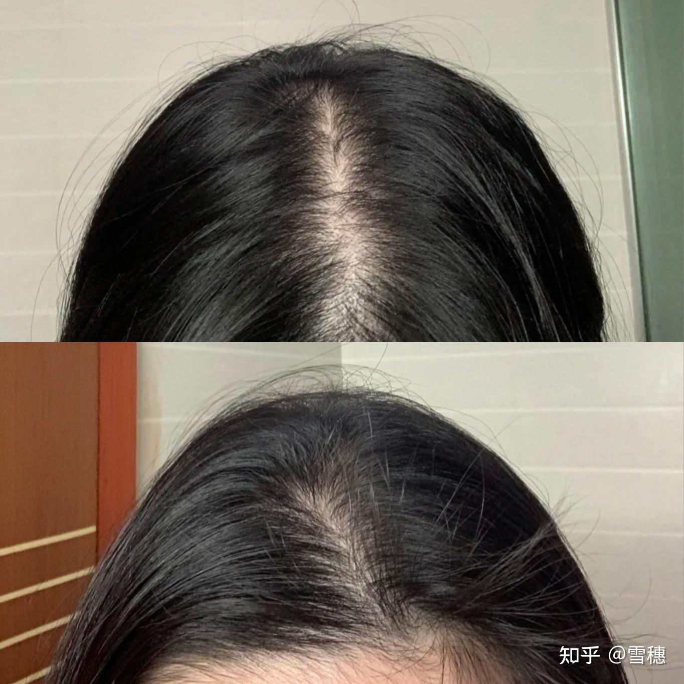 头顶头发很少,是不是脱发? - 知乎