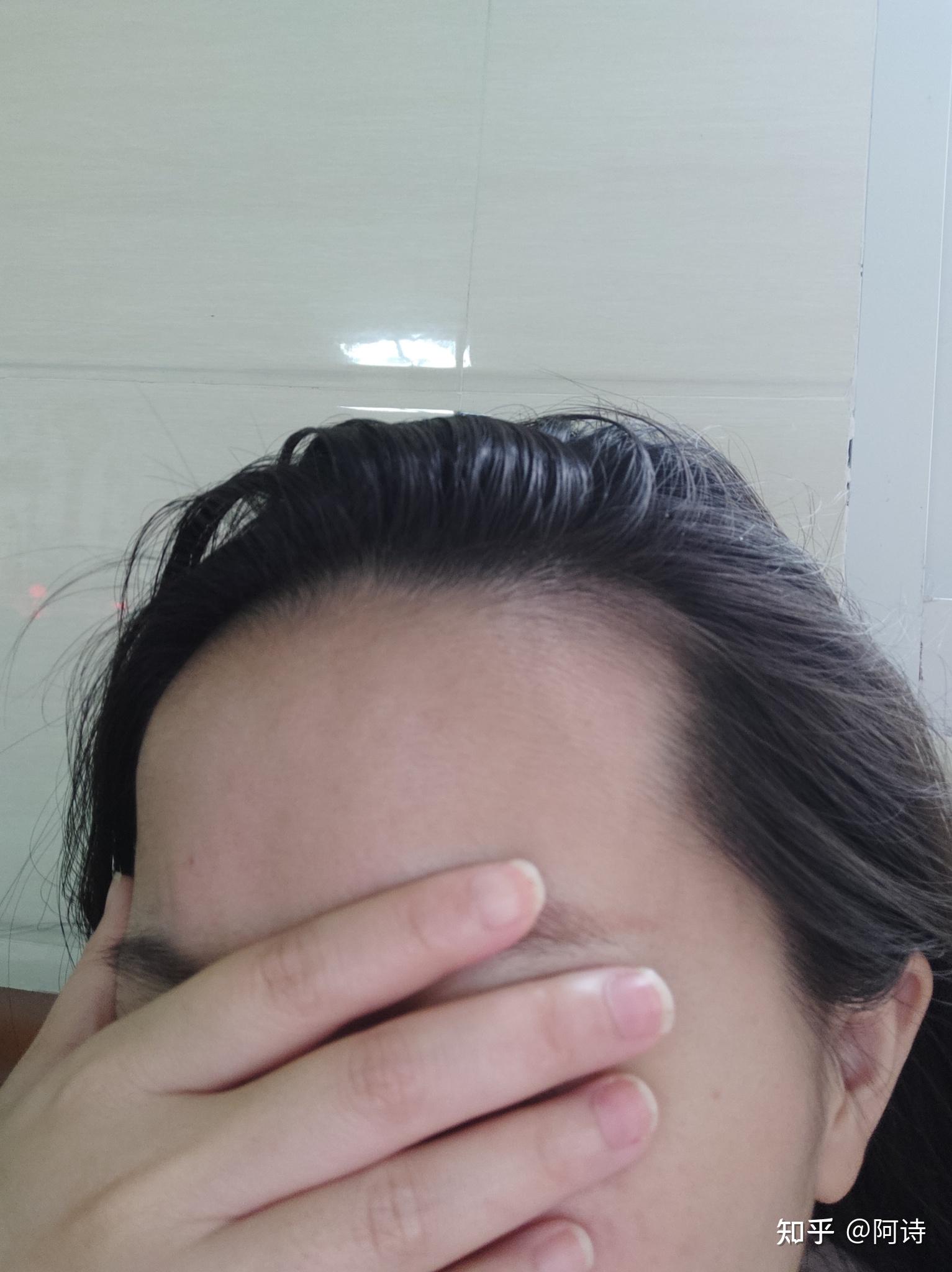 额头凸和发际线高这两点一般都会同时存在吗