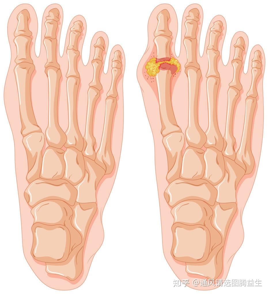 踝关节痛风的位置图图片