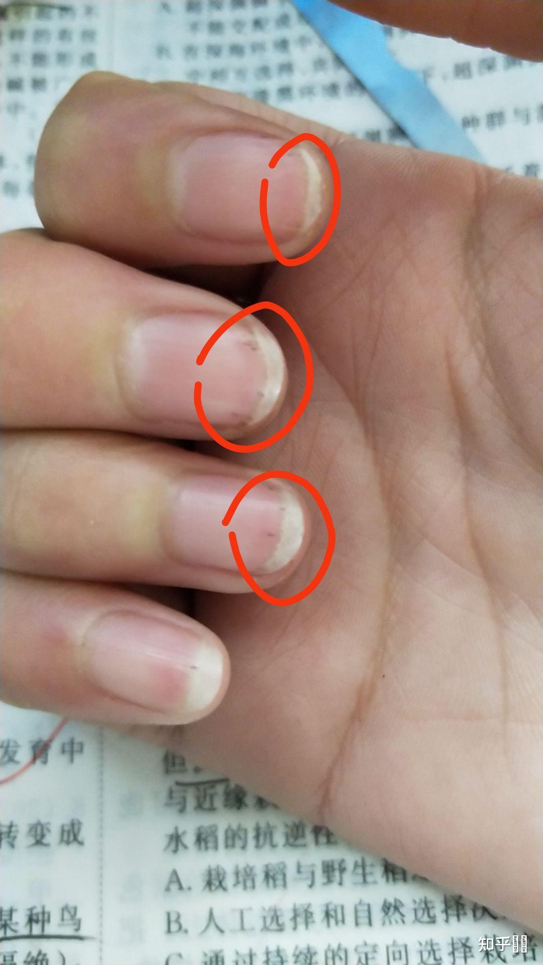 手指甲内长了多条黑褐色的竖纹,短短的,左右手每个手指都有,这是什么