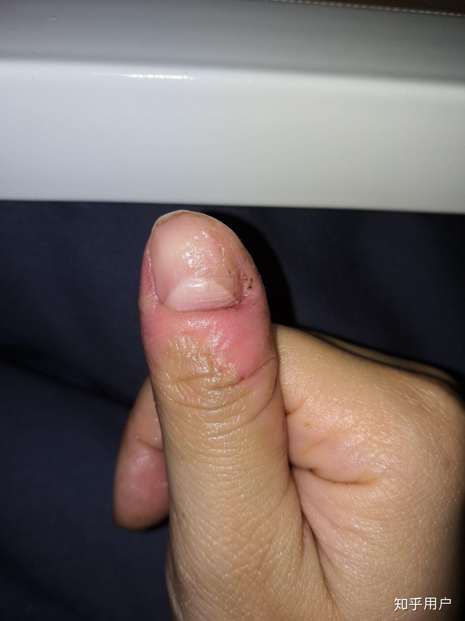 有喜欢抠指甲旁边的皮的吗