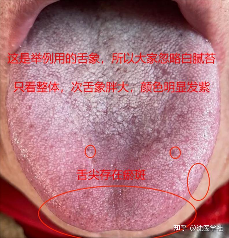 化瘀最好的方法是补阳，先血府逐瘀丸，再桂附地黄丸，瘀血化光光 - 知乎