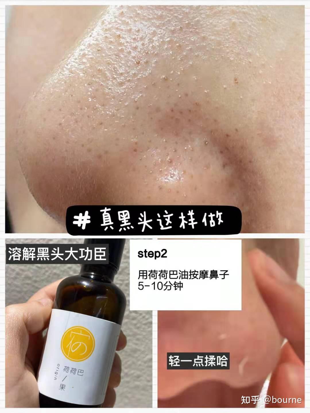 如何去黑头每天坚持涂阿达帕林凝胶脸也洗的很干净但就是去不掉有图