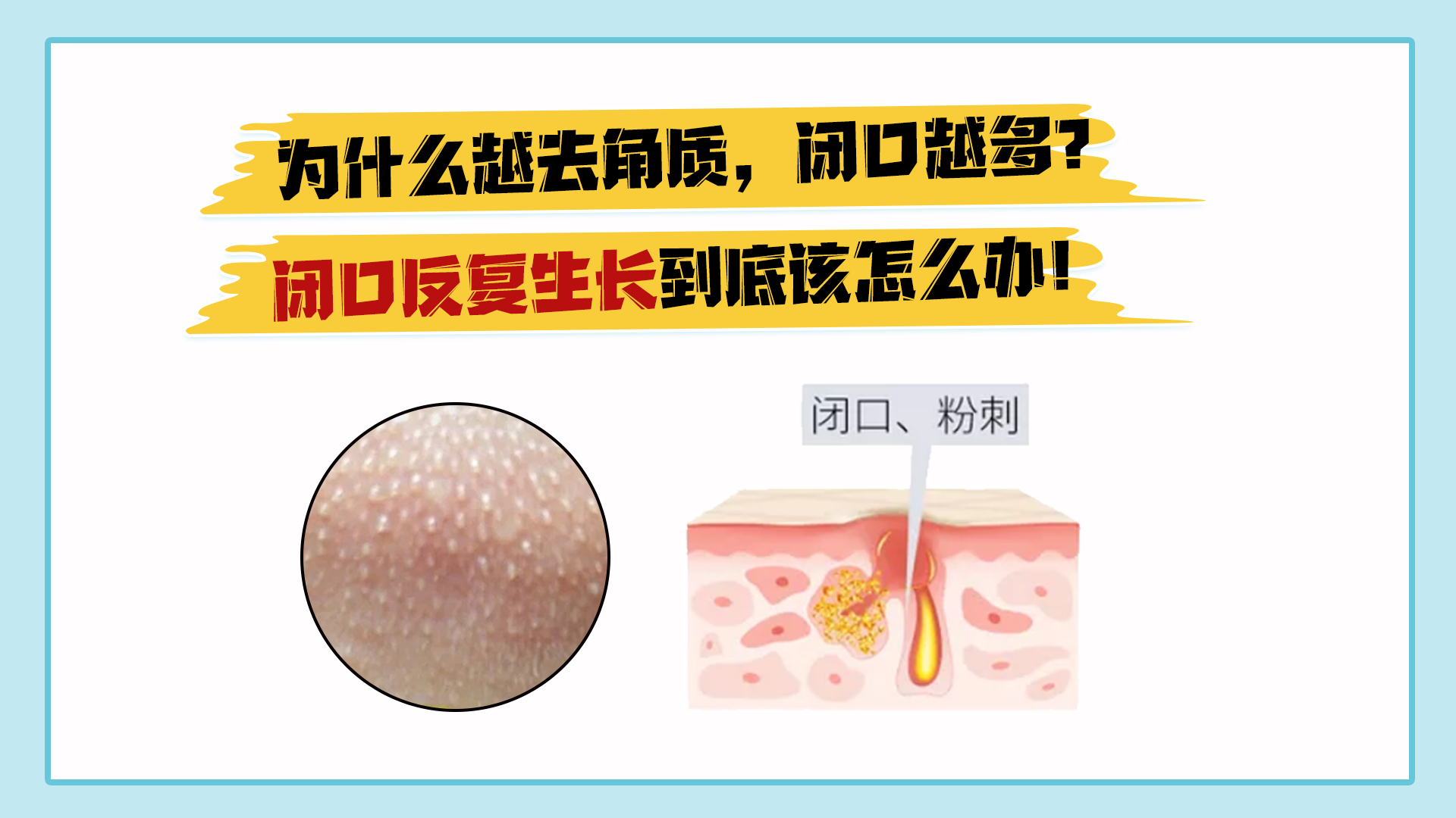 为什么越去角质,闭口越多? - 知乎