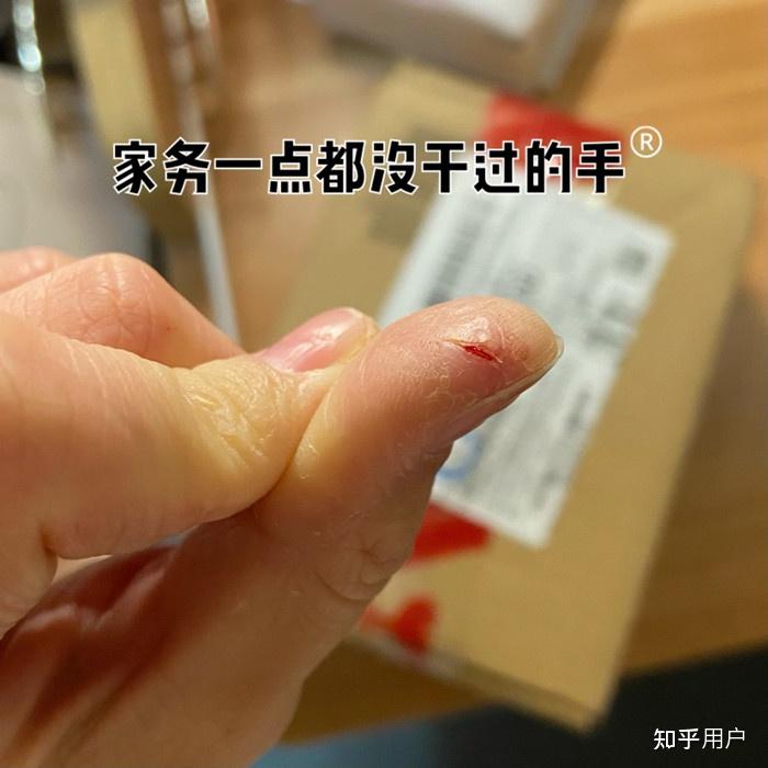 手上总是皲裂,是缺什么? - 知乎