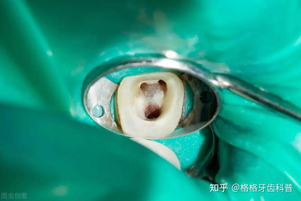 根管治疗断针了,问题大吗? - 知乎