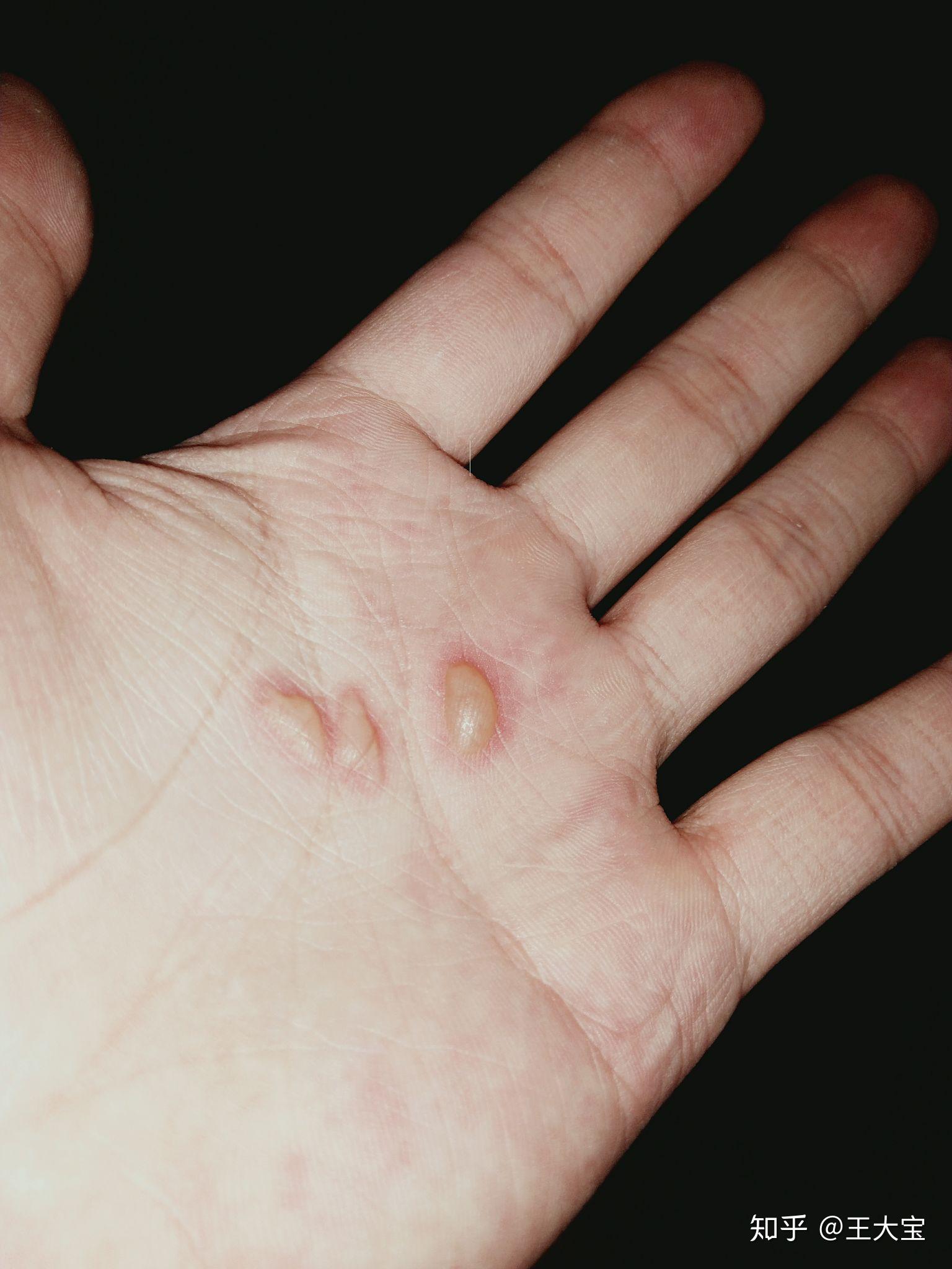 烫伤起的水泡可以戳破吗?