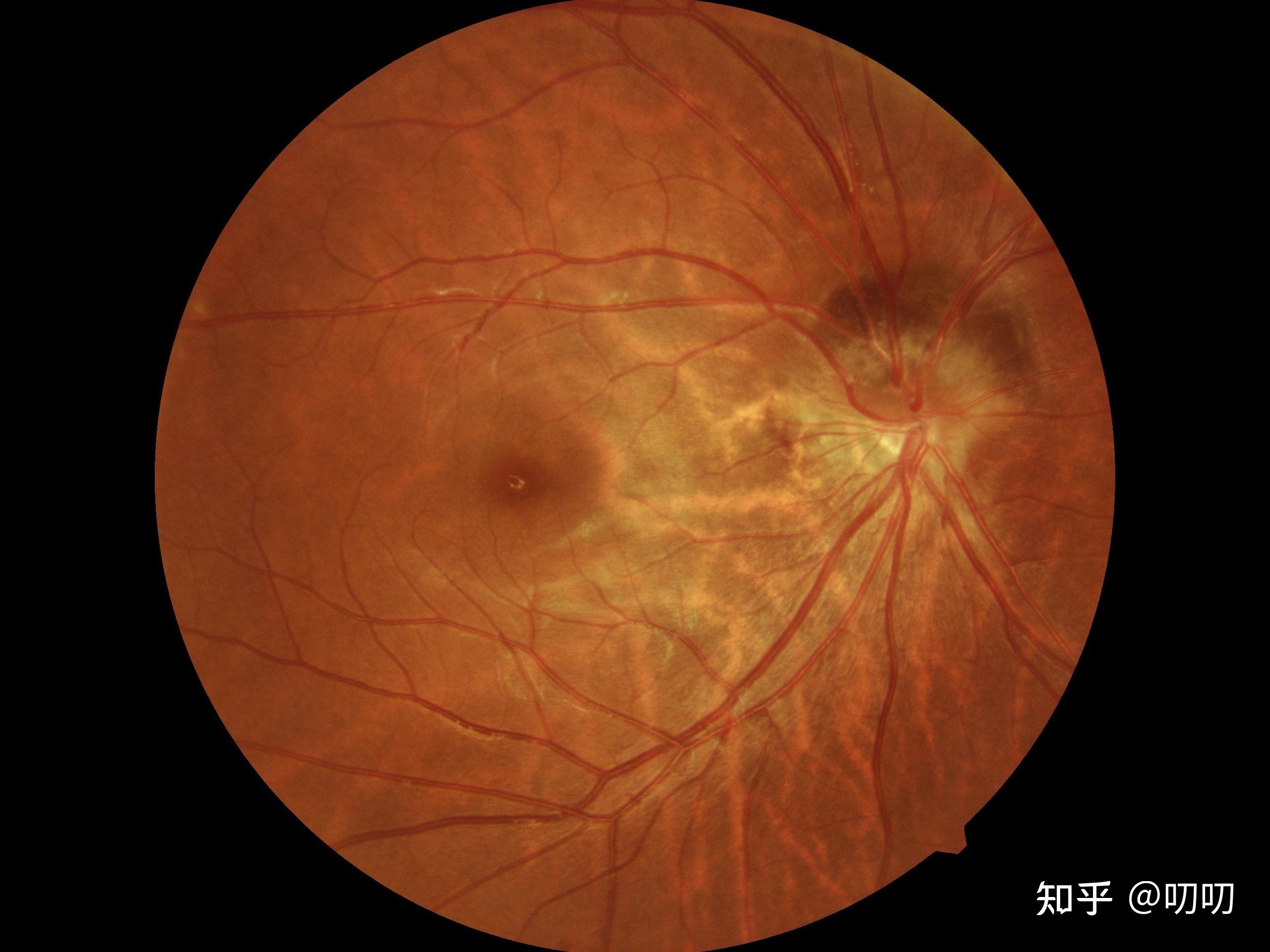 高度近视如何保护眼睛我初一都800度了以后学业更重而且听说国内大学