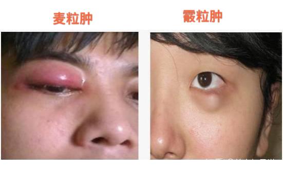 如何区分麦粒肿和霰粒肿