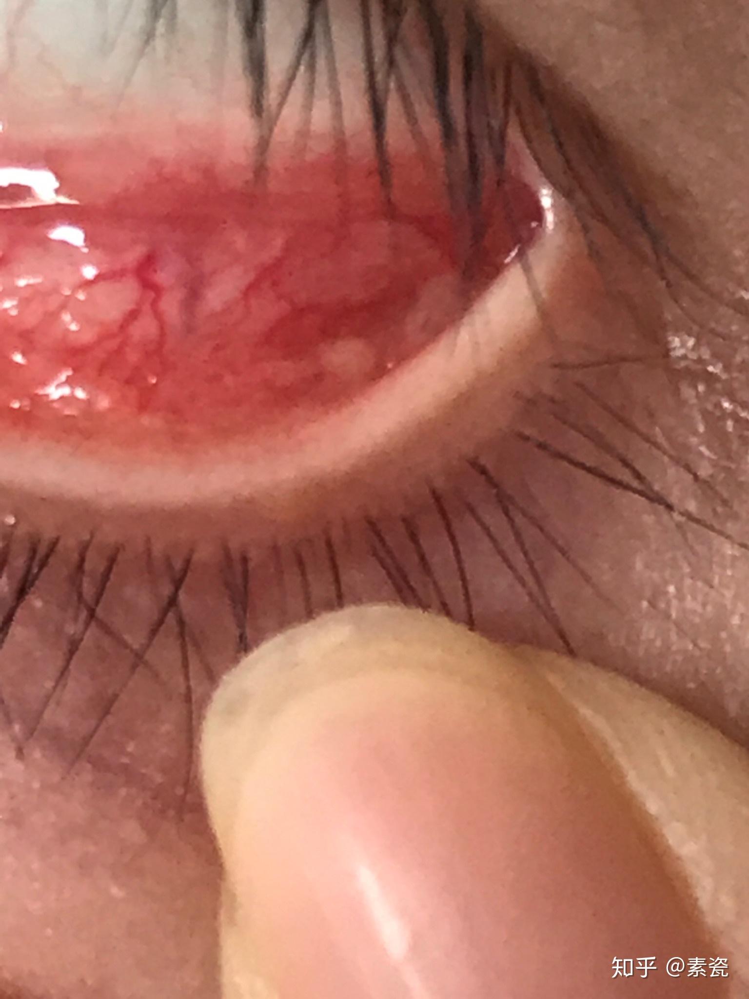 滤泡性结膜炎如何能有效治疗之前会怕光流眼泪眼干涩疼痛现在这些症状