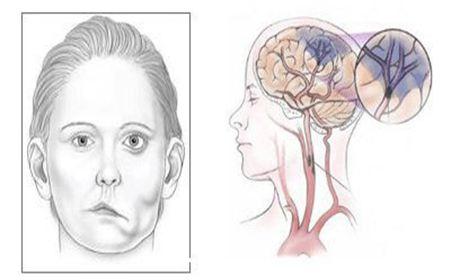 面肌痉挛的五大症状表现