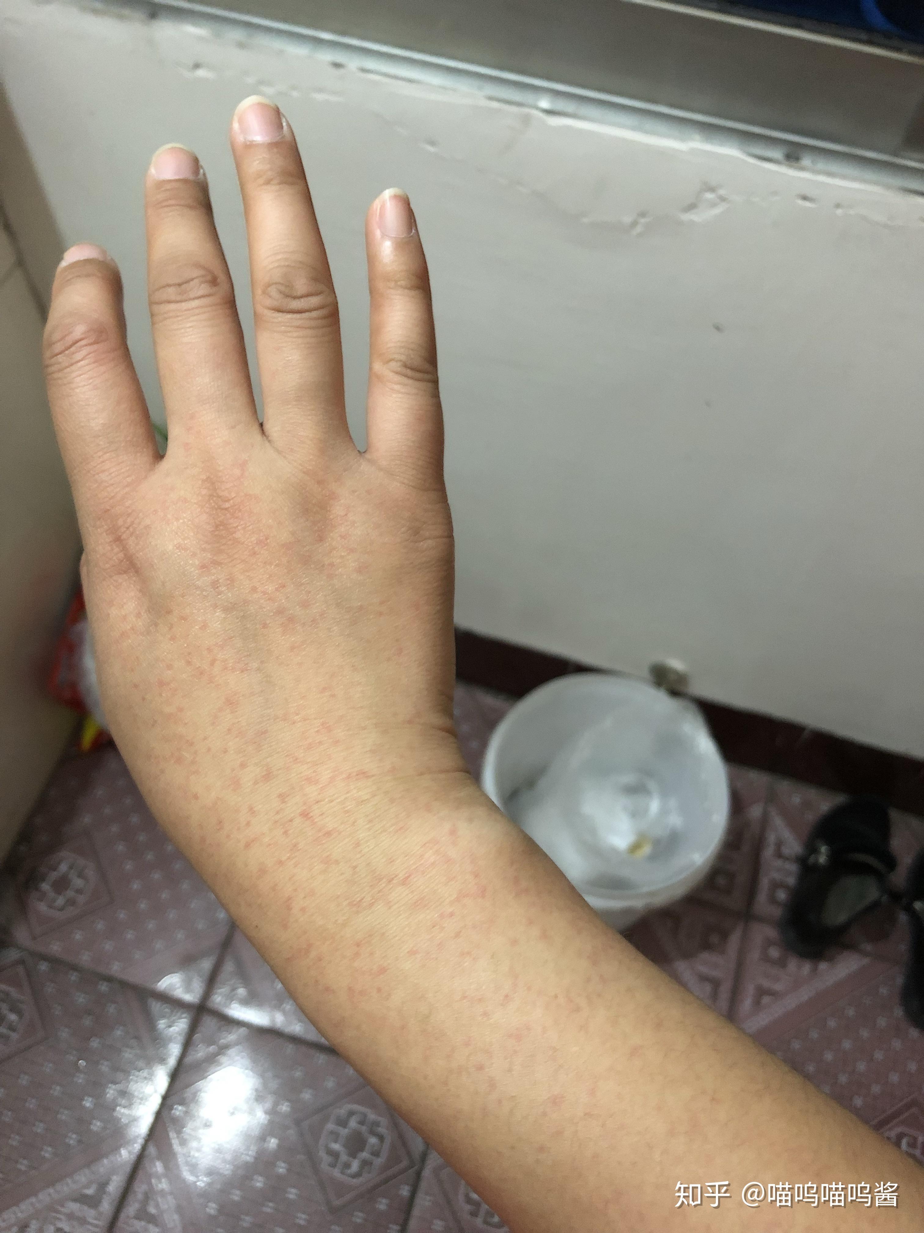 有没有小伙伴和我一样的荨麻疹症状上图