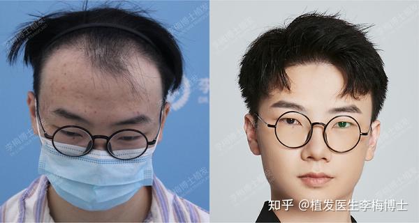 发际线多高算正常?