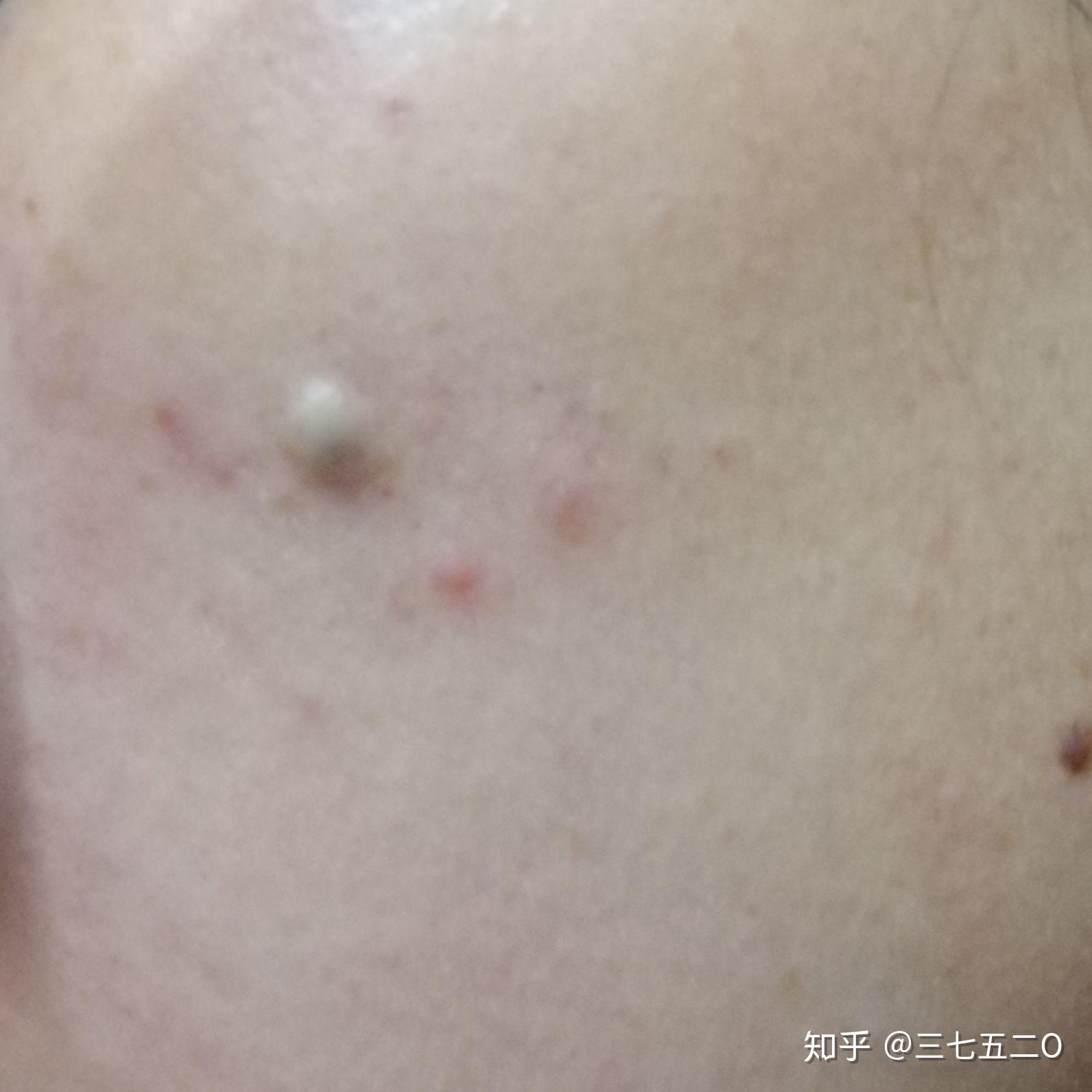 粉瘤如果不恶化,不做手术行不行? - 知乎