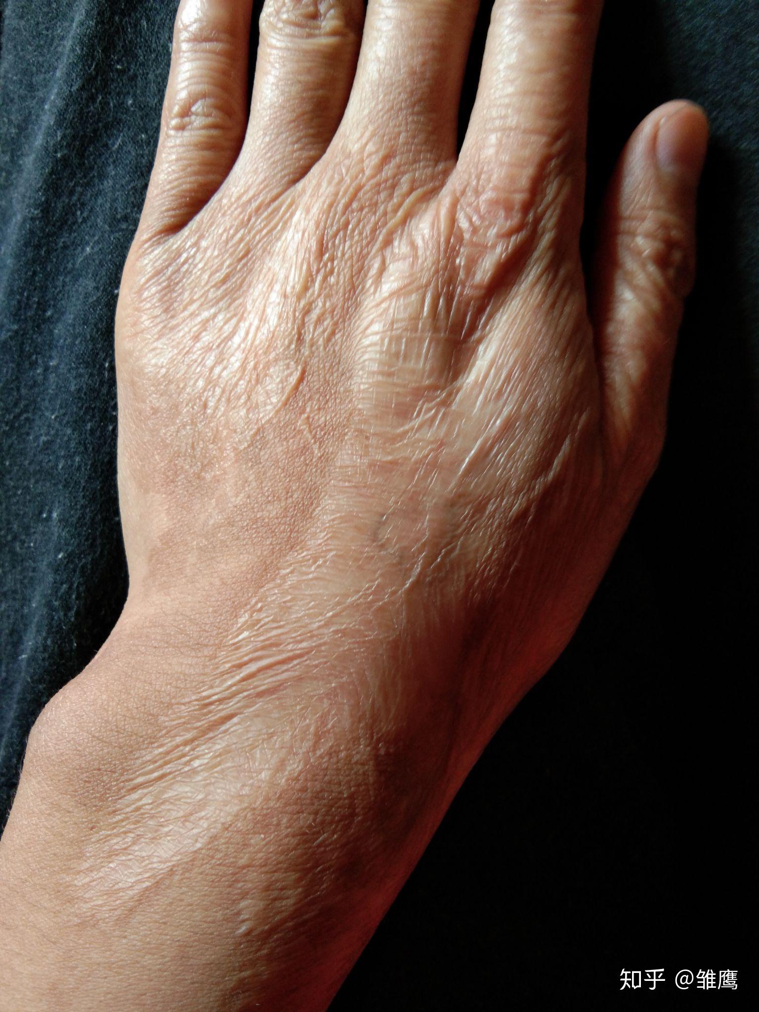 右手手背有很大疤痕,很自卑,找工作特别难,怎么办?