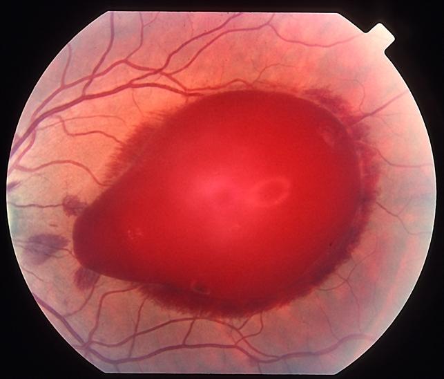 与外伤相关的视网膜病变——8,valsalva视网膜病变