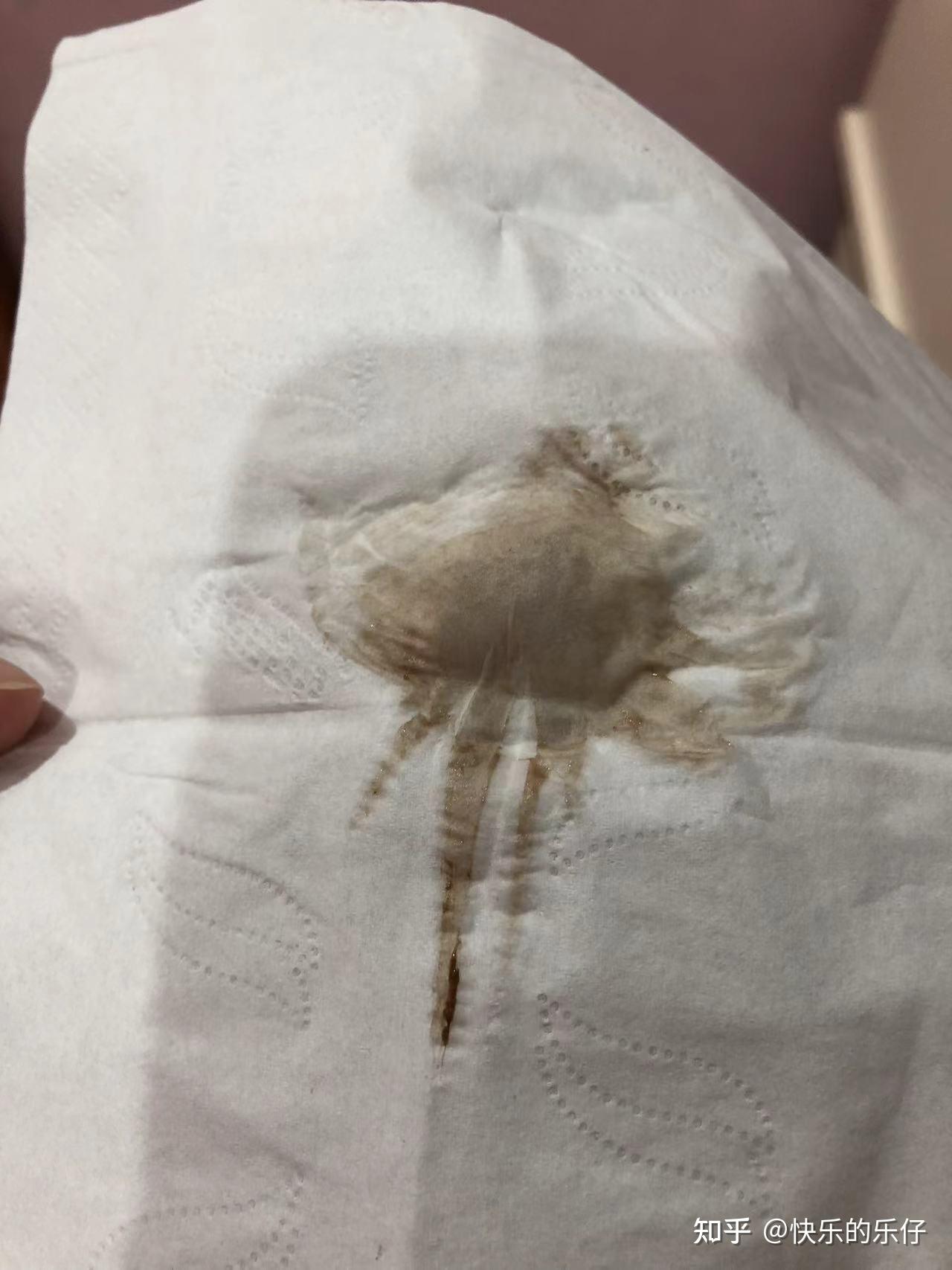 月经期间血呈现褐色,量很少不知道血还是什么,然后伴有块状和条线的