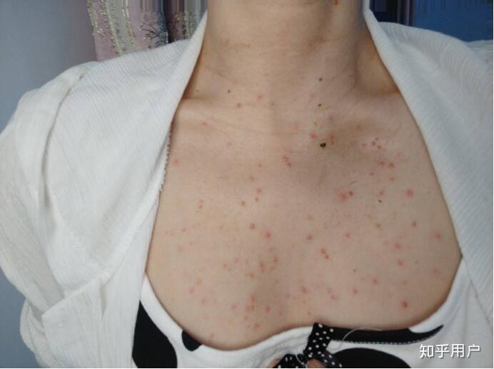 背上全是痘痘痘印怎么办啊