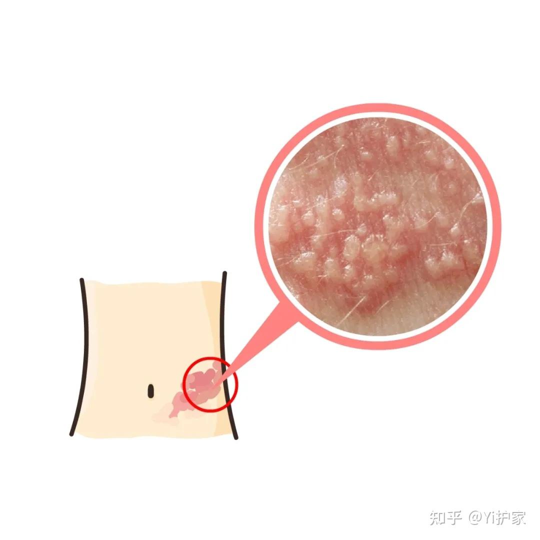 带状疱疹到底有多痛? - 知乎