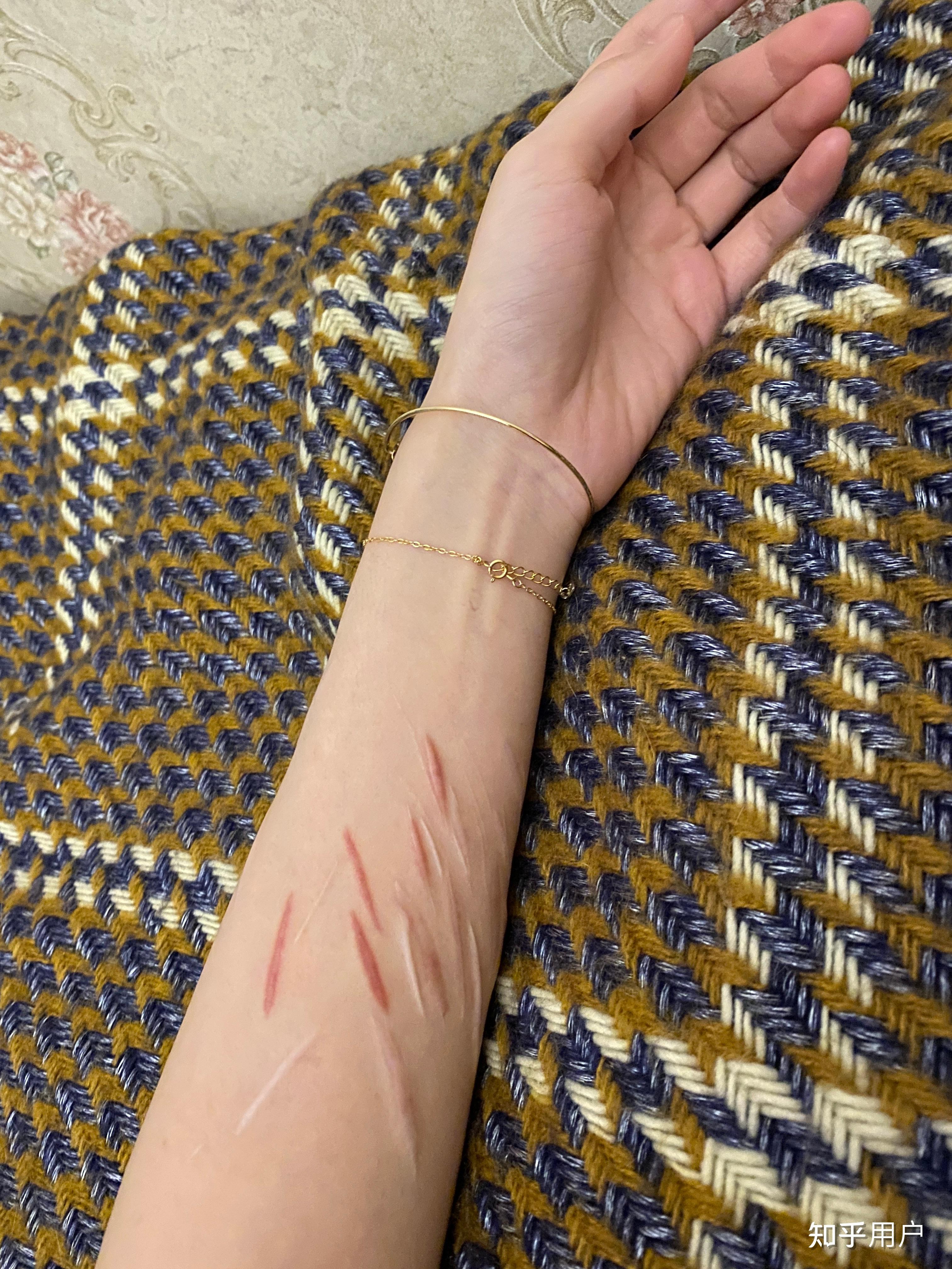 抑郁症患者夏天穿短袖自残痕迹直接露出他心理是怎么想的