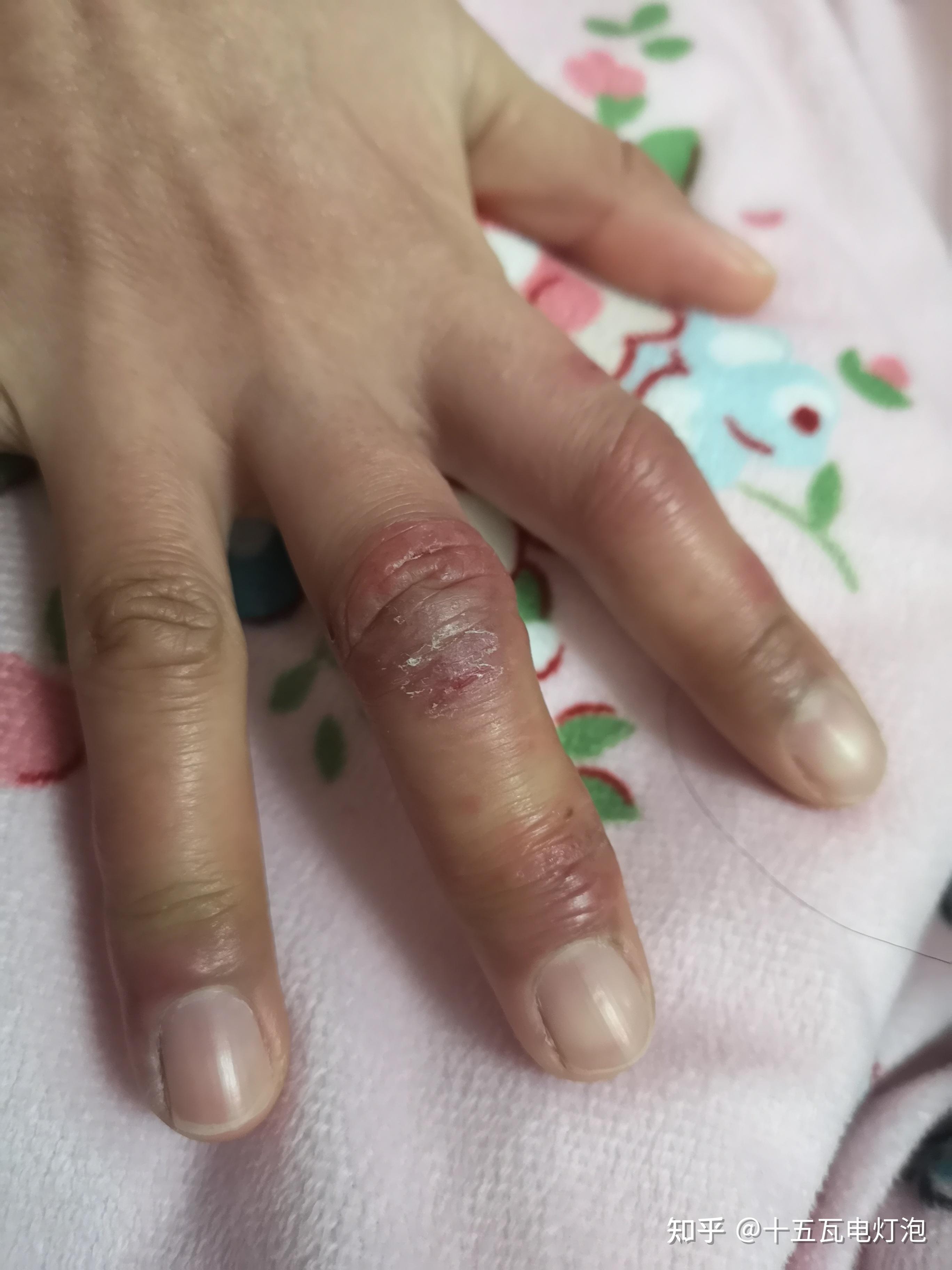 求冻疮膏推荐今年冷一定要是自己用过的真实感受用过没效果的也可以发