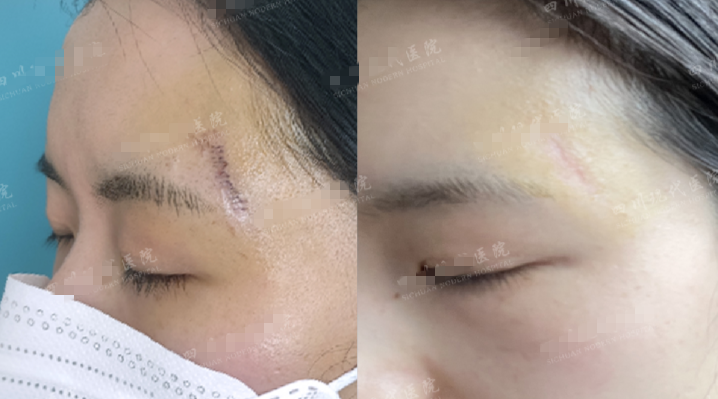 成都疤痕修复有哪些好的医院可以推荐一下的? - 知乎