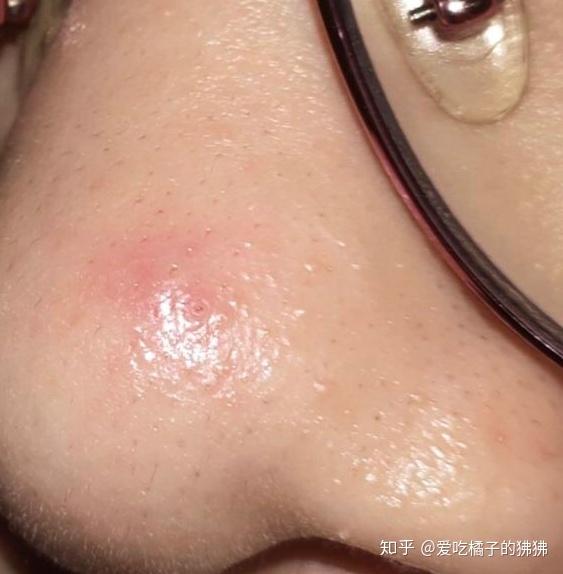 刚发几天的黑头被我扣出来留坑了怎么办怎么急救