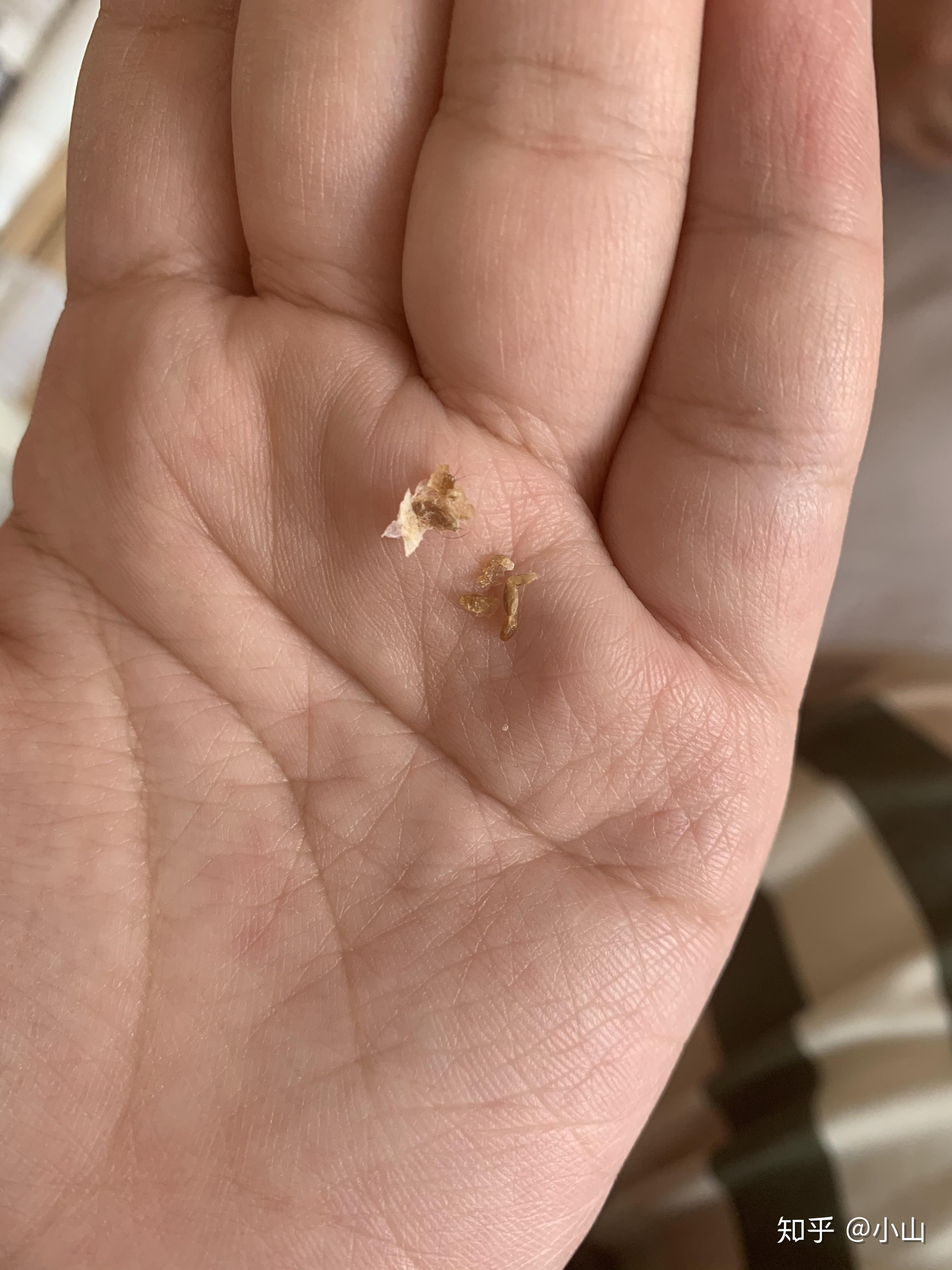 耳屎能大到什么程度?