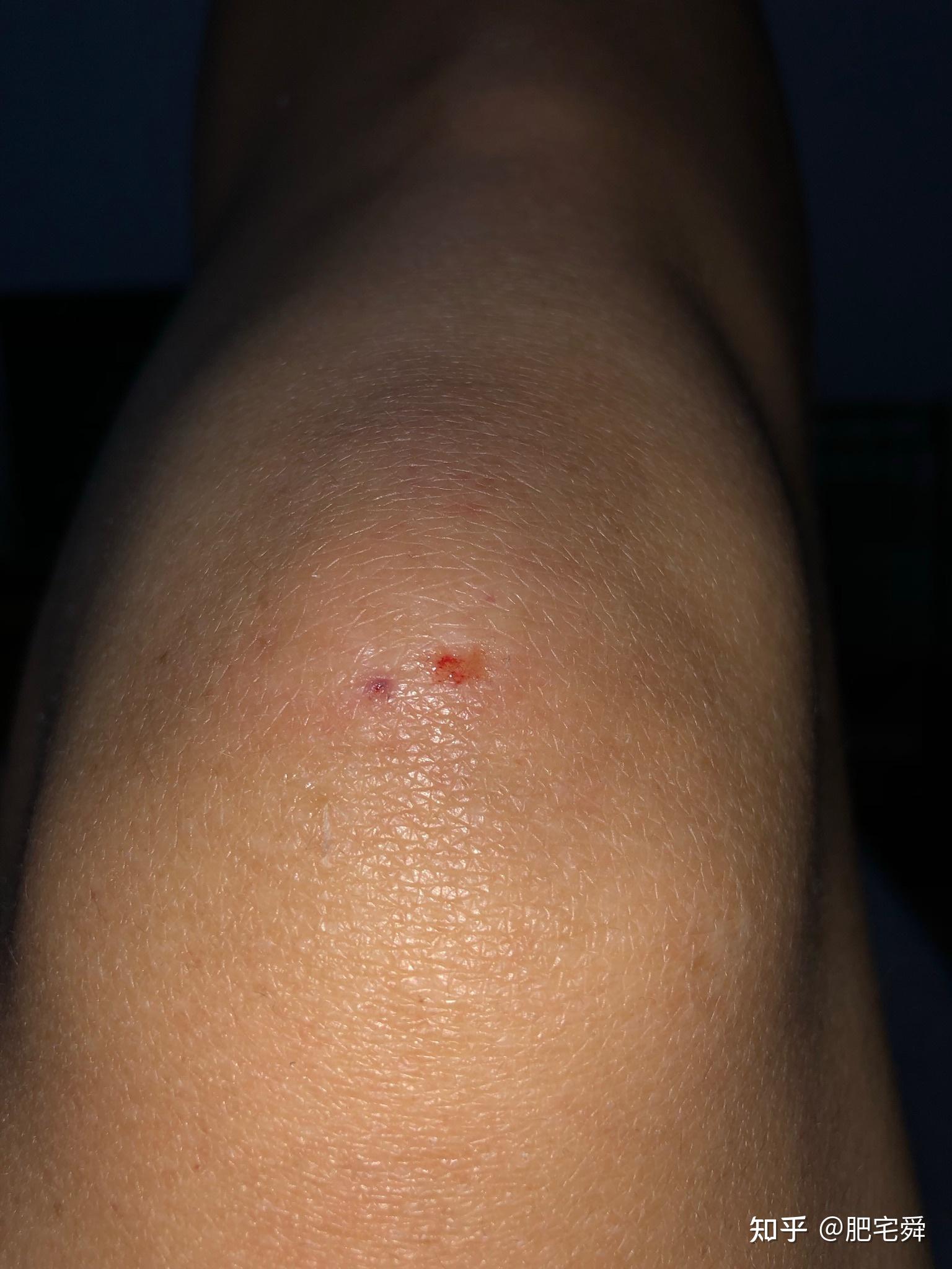 你们骑电动车摔过跤吗? - 知乎