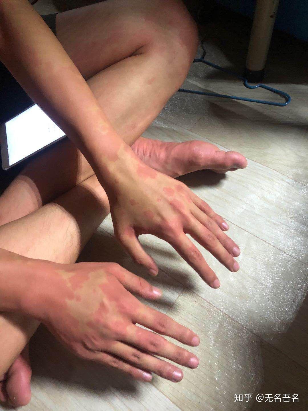 如何理解喝酒脸红和酒精过敏的区别