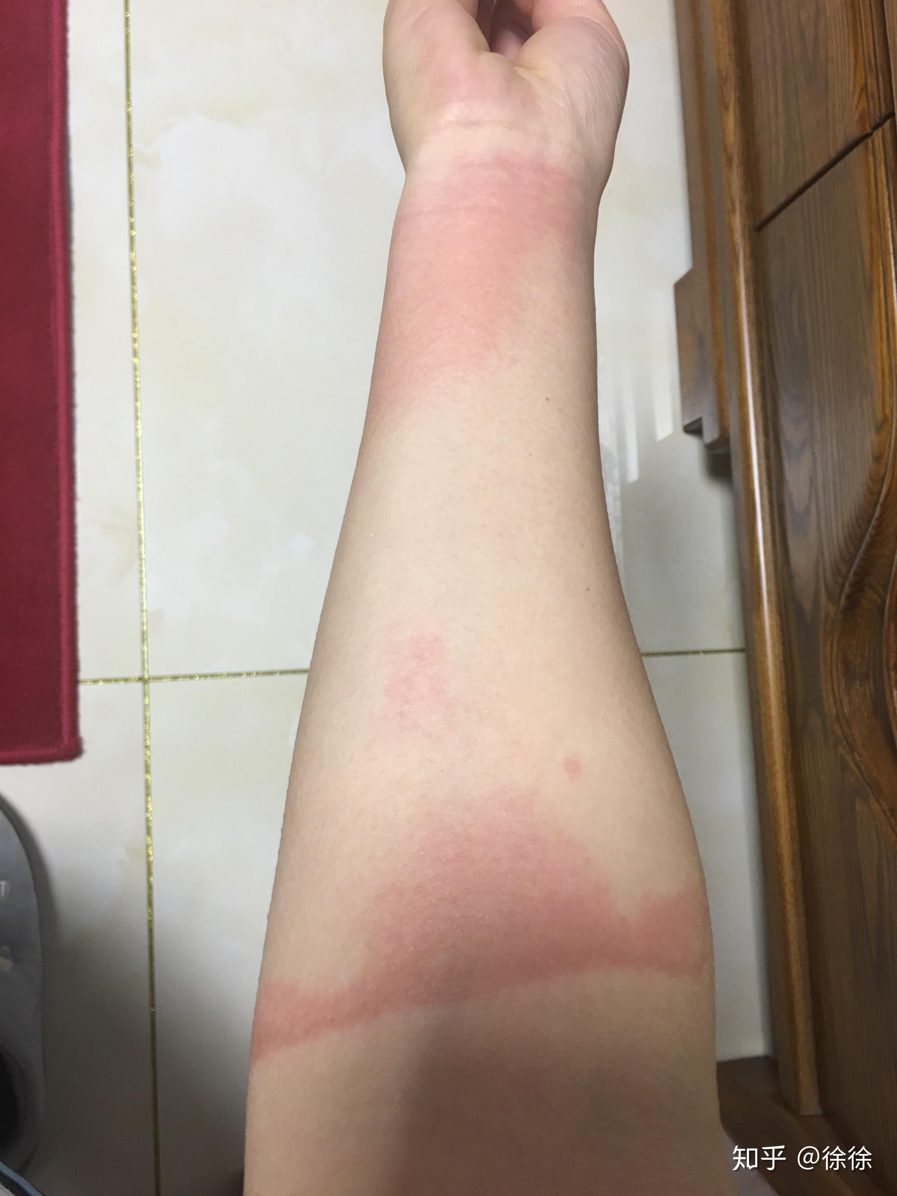 烫伤起的水泡可以戳破吗? - 知乎