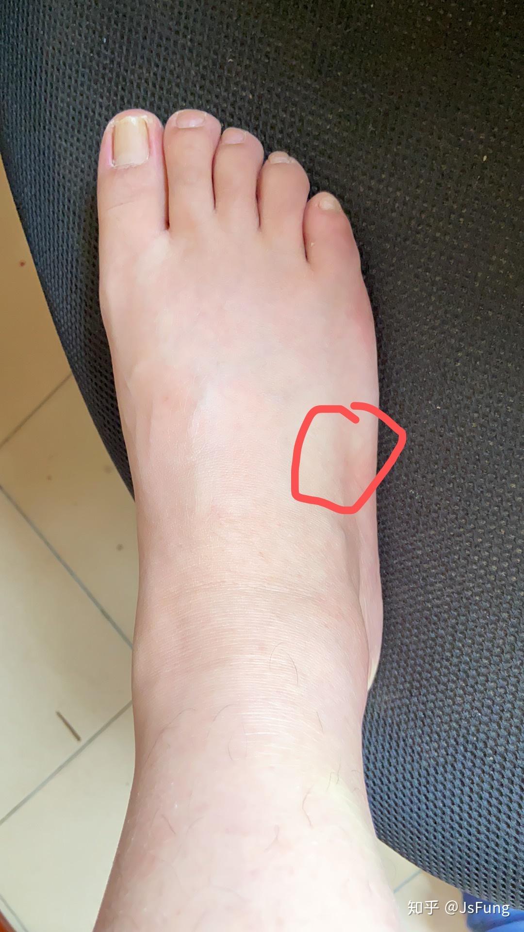 脚背无缘无故肿了而且走路很痛怎么回事