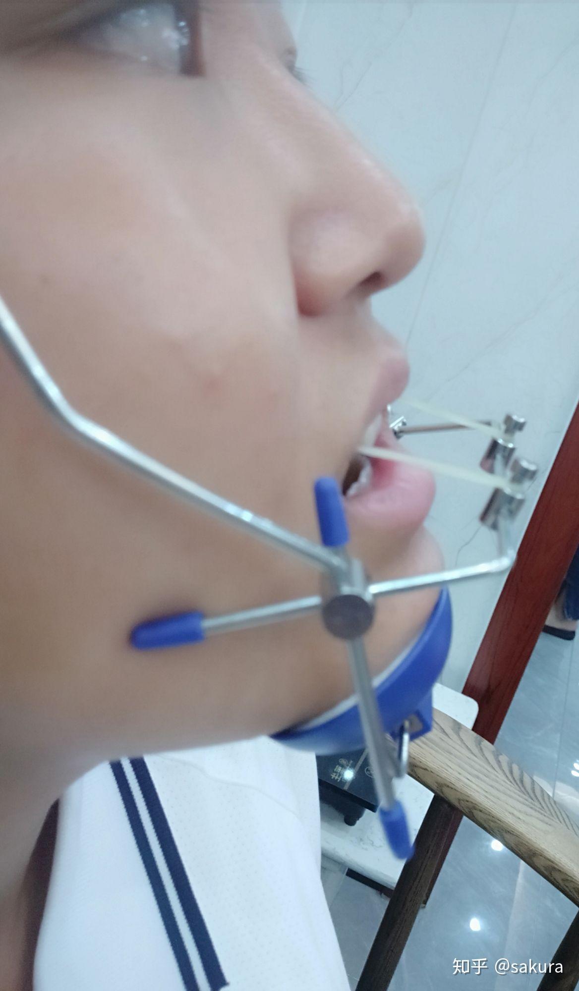 有没有治疗反颌地包天戴过矫治器面框的人呀