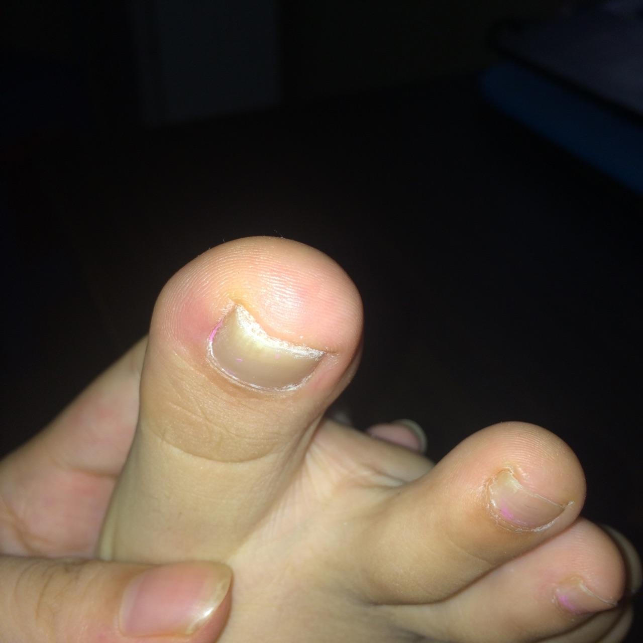 如何治疗甲剥离症? - 知乎