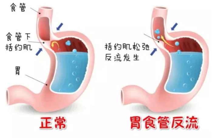 胃酸反流？你不是因为胃酸过多，而是胃酸过少！ - 知乎