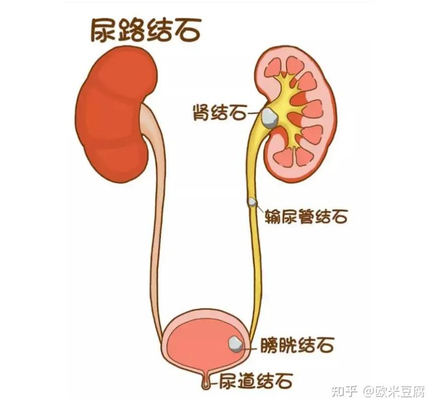 肾结石排石路线图图片