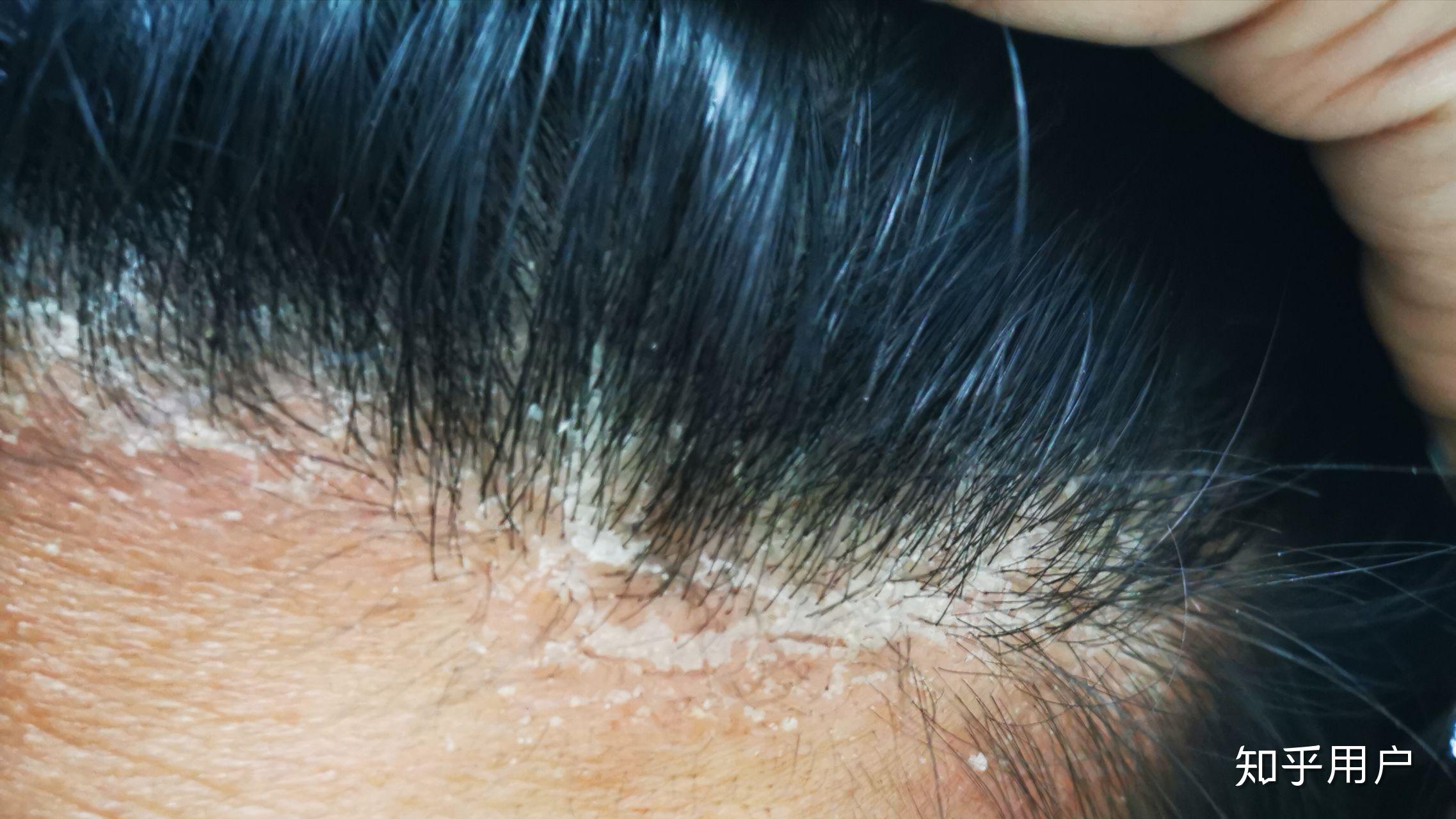 见过的最大头皮屑多大